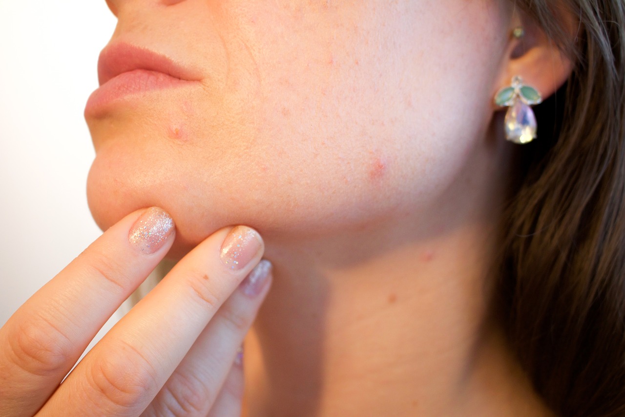 ¿Cómo prevenir el acné por uso de mascarilla?